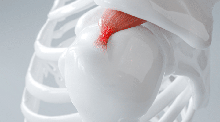 D visualization of a shoulder with calcific tendinitis, highlighting inflammation.