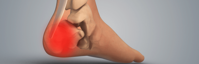 This stock image showcases a painful inflammation in the heel, focusing on the Effective Physical Therapy for Heel Pain Relief